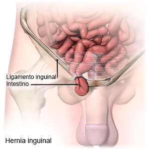 Hernia inguinal observando el paso del intestino por el conducto inguinal