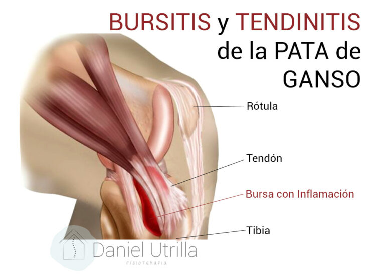 tenidinitis pata de ganso