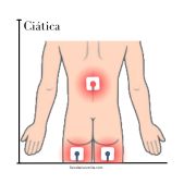 como colocar tens para ciatica