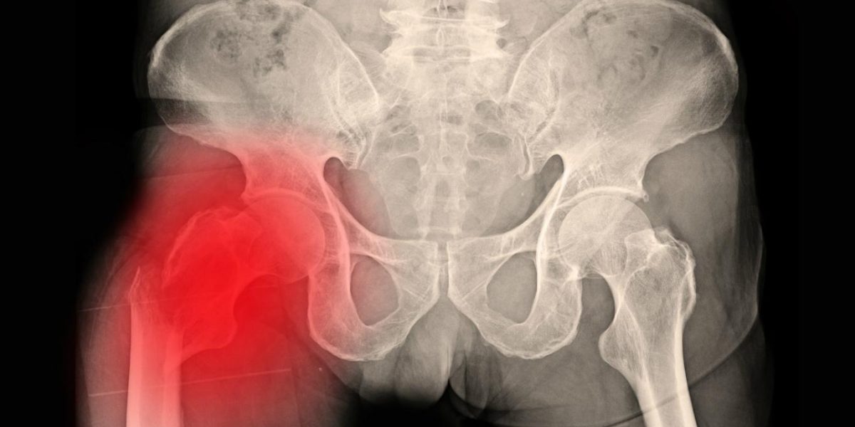 Fractura de cadera cómo ayudar