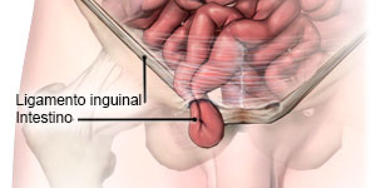 Hernia inguinal observando el paso del intestino por el conducto inguinal