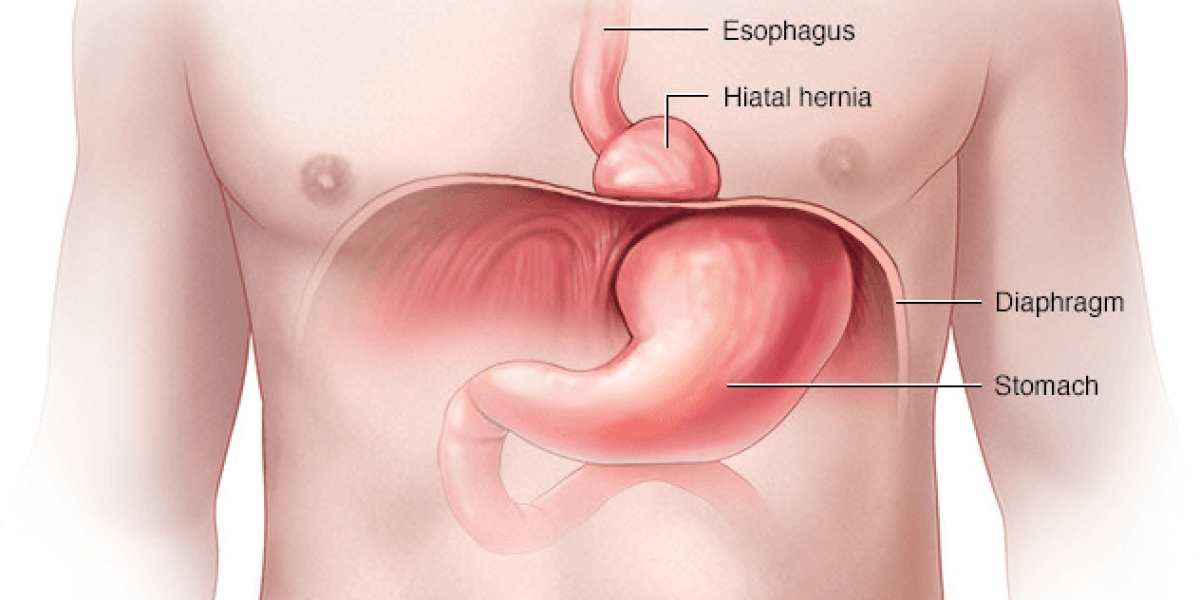 Hernia de hiato síntomas y tratamiento