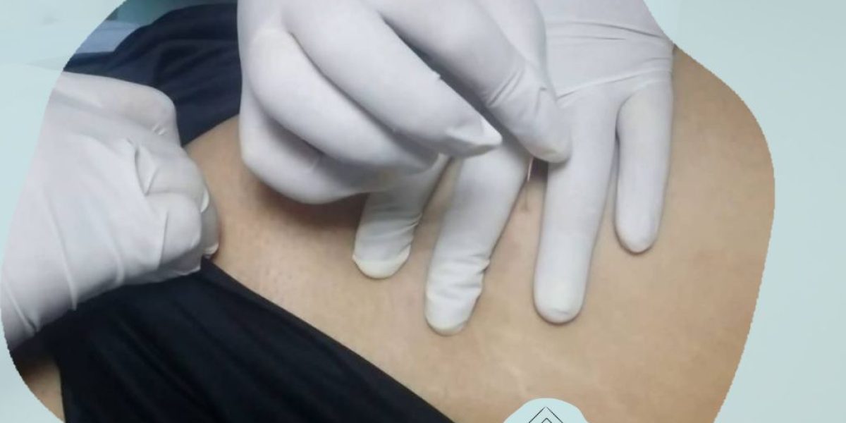 punción seca gluteo medio