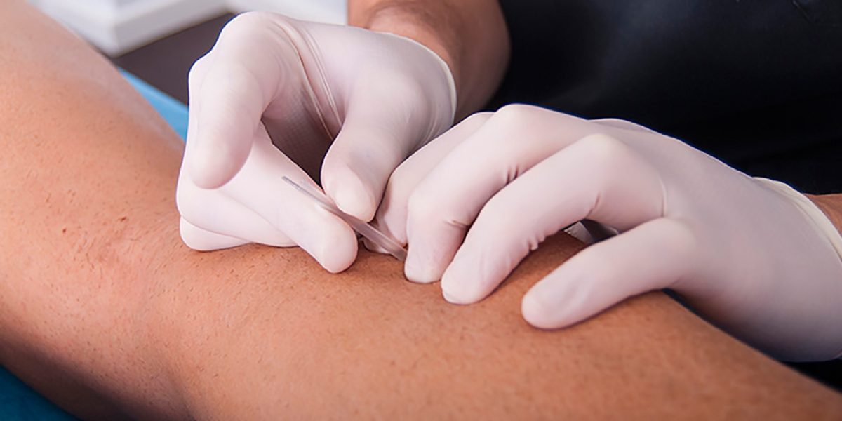 Punción seca y contracturas