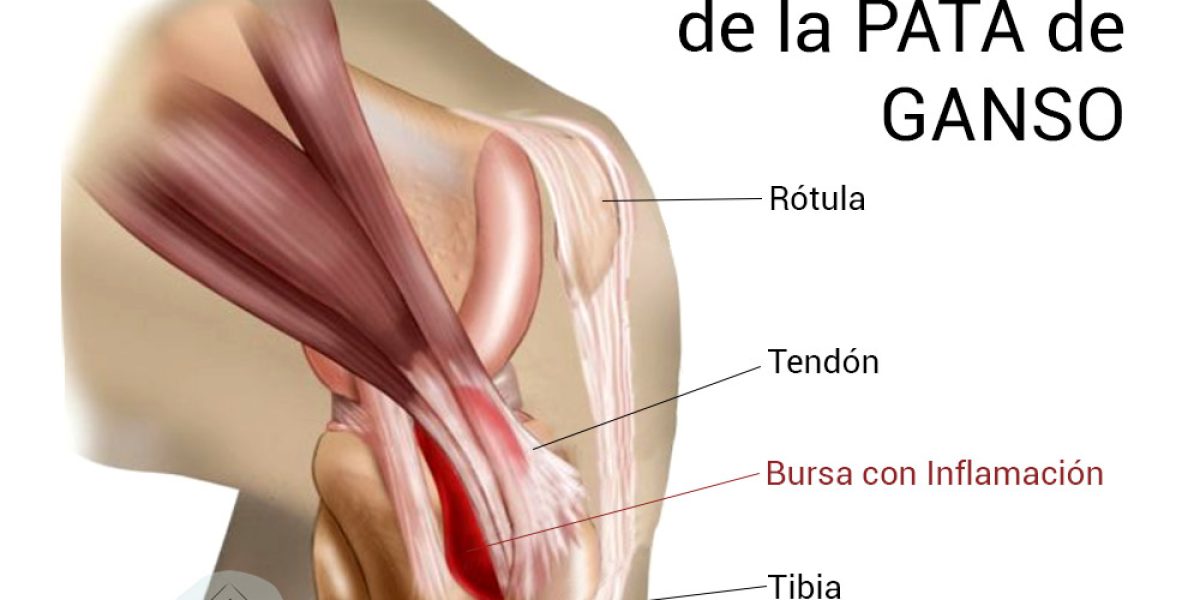 tenidinitis pata de ganso